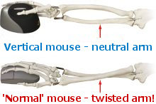 Illustration of a twisted arm when using a mouse from https://www.computer-posture.co.uk/mouse-elbow/